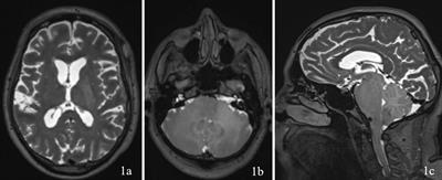 Unusual presentation of glioblastoma in the brainstem: a case report of a diffuse pontine glioblastoma multiforme and surgical management